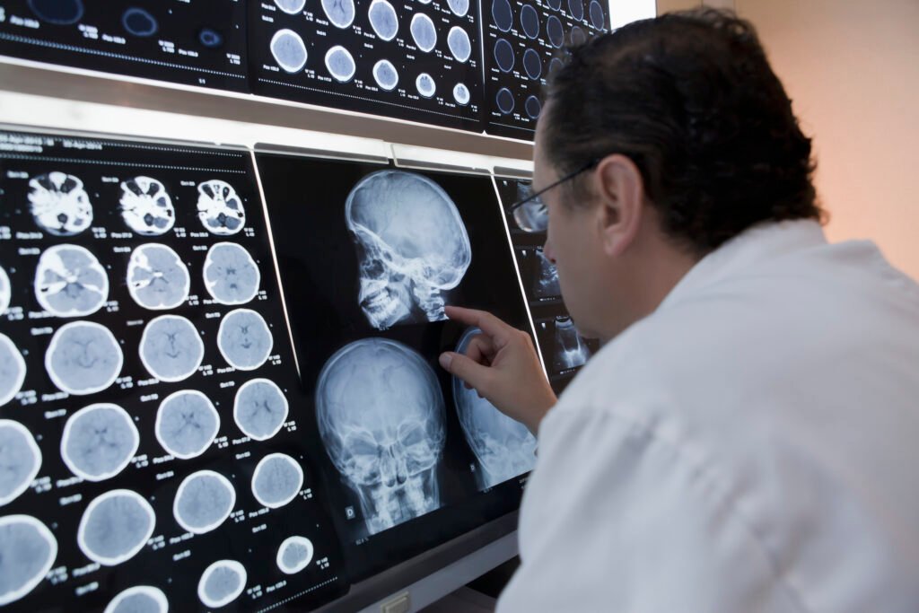 What Are the Symptoms of a Brain Tumor